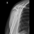 Shoulder joint x-ray image lateral view