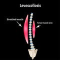 Left-sided scoliosis. Levoscoliosis. Muscles and spine. Spinal curvature in scoliosis. Infographics. Vector illustration