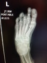 Left third toe proximal phalanx amputation - plain x-ray