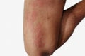 Leg area of man with dermatitis problem of rash ,allergy rash