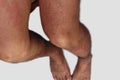 Leg area of man with dermatitis problem of rash ,allergy rash