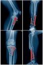 Leg bone fixation