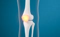 Leg bone and knee lesions, 3d rendering