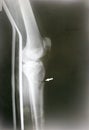 Leg fracture x-ray