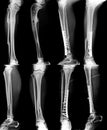 Fracture of leg and osteoathritis Royalty Free Stock Photo