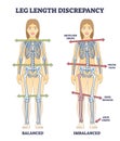Leg length discrepancy condition with imbalanced skeleton outline diagram Royalty Free Stock Photo