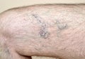 Leg of a man with varicose veins and capillaries Royalty Free Stock Photo