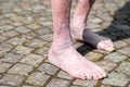 Leg of an old person with circulatory problems Royalty Free Stock Photo