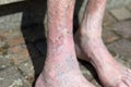 Leg of an old person with circulatory problems