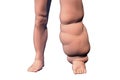 Leg of a person with elephantiasis, lymphatic filariasis