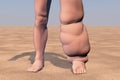 Leg of a person with elephantiasis, lymphatic filariasis