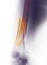 Leg X-ray, fracture of distal femur