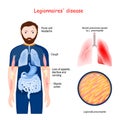 Legionnaires` disease. atypical pneumonia caused by bacteria Legionella Royalty Free Stock Photo