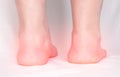 Legs of an adult woman on a white background with heel spurs, close-up, plantar fasciitis, orthopedist