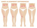 Legs and angles of the knees, different types of leg shapes. Normal varus and valgus