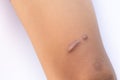 The legs of an Asian boy are scarred, convex and hard. Caused by surgical wounds and stitches,Isolate white background,The legs of