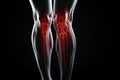 Legs of a man with knee pain in the form of an x-ray on a dark background. Tendon problems and joint inflammation Royalty Free Stock Photo