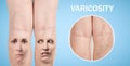 Legs with varicose veins