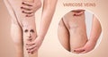 Legs with varicose veins