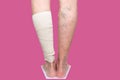 Legs. Varicose veins. Phlebeurysm. Thrombophlebitis. Elastic bandage