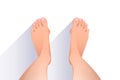 Top view of bare feet with hallux valgus