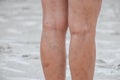 Legs of women, scars and varicose veins.