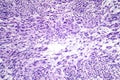 Leiomyoma, or fibroids, is a benign smooth muscle tumor Royalty Free Stock Photo