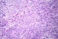 Leiomyosarcoma, light micrograph