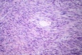 Leiomyosarcoma, light micrograph