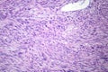 Leiomyosarcoma, light micrograph