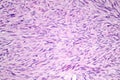Leiomyosarcoma, a malignant cancerous smooth muscle tumor Royalty Free Stock Photo