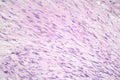 Leiomyosarcoma, a malignant cancerous smooth muscle tumor