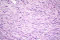 Leiomyosarcoma, a malignant cancerous smooth muscle tumor