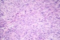 Leiomyosarcoma, a malignant cancerous smooth muscle tumor