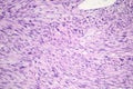 Leiomyosarcoma, a malignant cancerous smooth muscle tumor