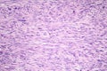 Leiomyosarcoma, a malignant cancerous smooth muscle tumor