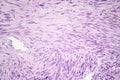 Leiomyosarcoma, a malignant cancerous smooth muscle tumor