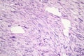 Leiomyosarcoma, a malignant cancerous smooth muscle tumor