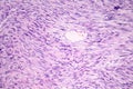 Leiomyosarcoma, a malignant cancerous smooth muscle tumor