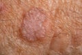 Lesion of actinic keratosis or sunspots man Royalty Free Stock Photo