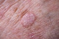 Lesion of actinic keratosis or sunspots man. Detail Royalty Free Stock Photo