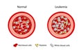 Leukemia, blood cancer. Difference between healthy normal blood and blood cancer. Royalty Free Stock Photo