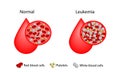 Leukemia, blood cancer. Difference between healthy normal blood and blood cancer.