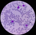 Leukemia. blood cells, blast cells and immature leukocytic cells in chronic lymphocytic leukemia