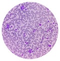 Leukemia. blood cells, blast cells and immature leukocytic cells in chronic lymphocytic leukemia