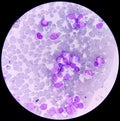 Leukemia. blood cells, blast cells and immature leukocytic cells in chronic lymphocytic leukemia
