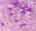 Leukemia. blood cells, blast cells and immature leukocytic cells.