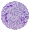 Leukemia. blood cells, blast cells and immature leukocytic cells in chronic lymphocytic leukemia