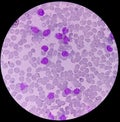 Leukemia. blood cells, blast cells and immature leukocytic cells in chronic lymphocytic leukemia