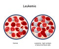 Leukemia. Blood of healthy person and blood cancer